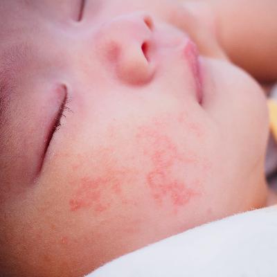 How To Prevent Eczema & Ways To Treat It