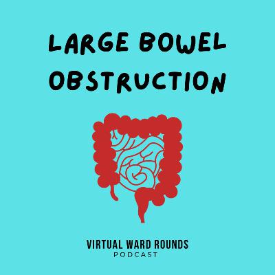 Large Bowel Obstruction Large Bowel Obstruction