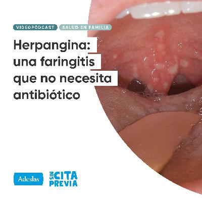 198 Herpangina: una faringitis que no necesita antibiótico 198 Herpangina: una faringitis que no necesita antibiótico
