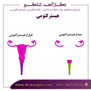 عمل خارج کردن رحم یا هیسترکتومی