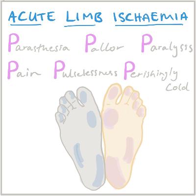 Acute Limb Ischaemia Acute Limb Ischaemia