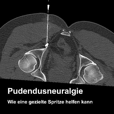Pudendusneuralgie – Wenn der Nerv im Becken schmerzt Pudendusneuralgie – Wenn der Nerv im Becken schmerzt