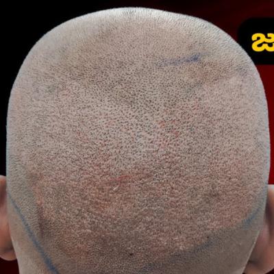 Why do celebrities not show an empty donor patch after graft extraction? Do ordinary people undergo a different type of hair transplant? Why do celebrities not show an empty donor patch after graft extraction? Do ordinary people undergo a different type of hair transplant?