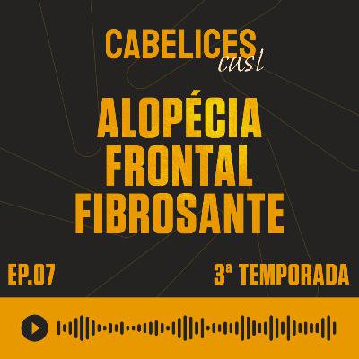Alopecia Frontal Fibrosante Alopecia Frontal Fibrosante