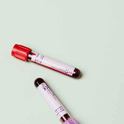 Episode 12: Early test alert to Alzheimer’s
