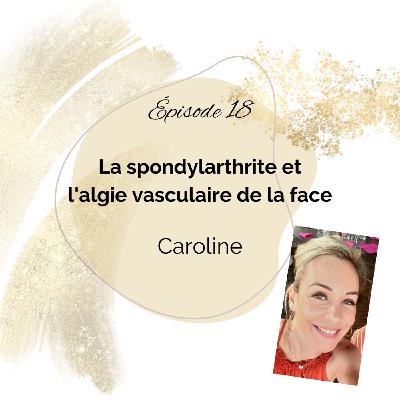 18 - Spondylarthrite et Algie vasculaire de la face - Caroline