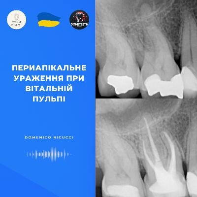 Периапікальне ураження при вітальній пульпі
