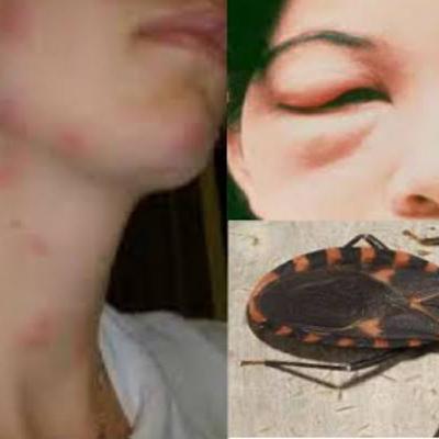 Caso Clínico - Doença de Chagas