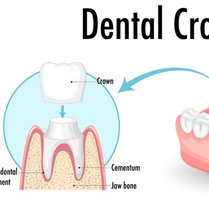Are Dental Crowns or Bridges Right for You?