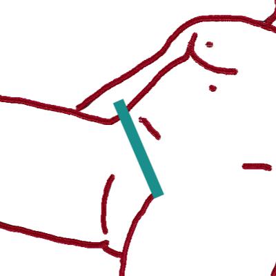 Episodio 45: Un vistazo a la eco de cadera de adulto