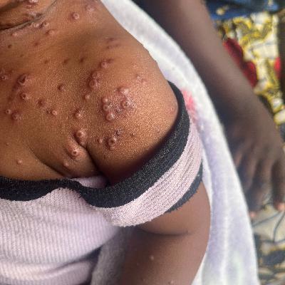 Los síntomas de Monkeypox clade Ib!!!!! Los síntomas de Monkeypox clade Ib!!!!!