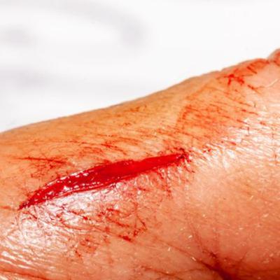 How Long Does It Take for a Laceration Wound or Deep Cut to Heal? – Learn the healing stages, recovery time, and factors that affect wound healing.