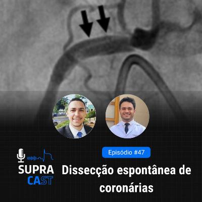 47. Dissecção Espontânea de Coronárias