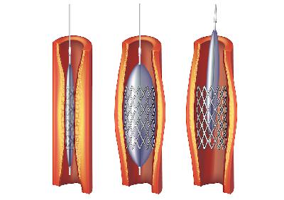 10 Things Everyone Who Has Had a Coronary Stent or Bypass Operation Should Know