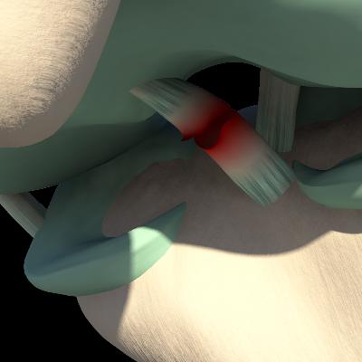 Quando Operar o Ligamento Cruzado Anterior