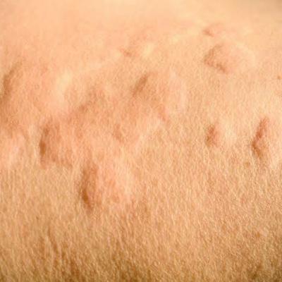 Mx of Acute contrast reaction (Hives/urticaria and diffuse erythema)