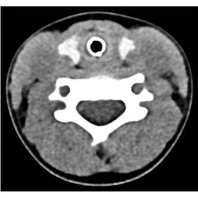 Peeking Inside Breathing Tubes in Kids