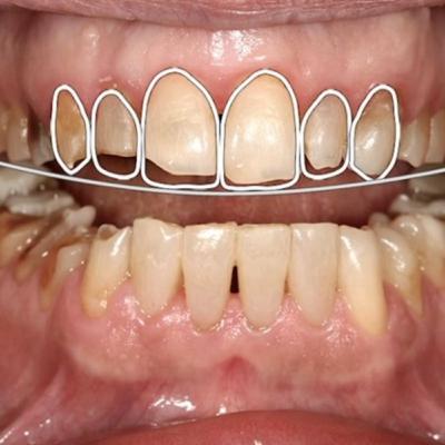 فرسایش دندانی Tooth Wear فرسایش دندانی Tooth Wear