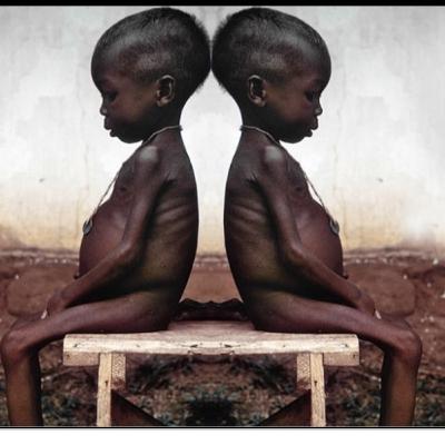 Impactante tasa de muertes por desnutrición en niños menores de 5 años en la Guajira.