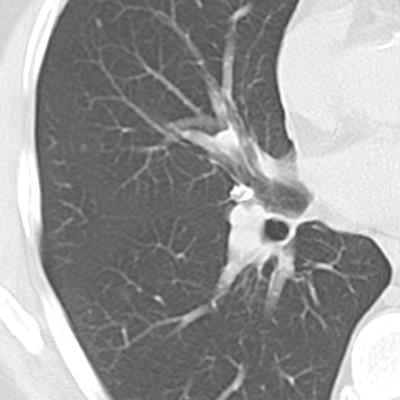 Ep.6 - O dilema do nódulo do pulmão Ep.6 - O dilema do nódulo do pulmão