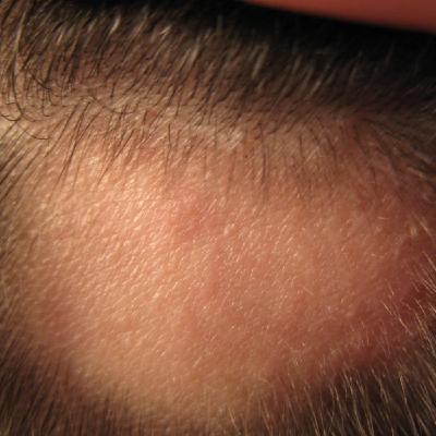 Alopecia y Tratamientos capilares
