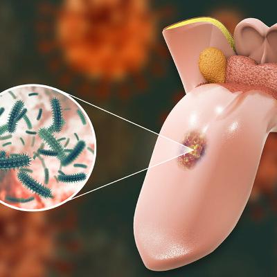 Audio Article: How Hygienists Can Be the First Line of Defense Against Oral Cancer