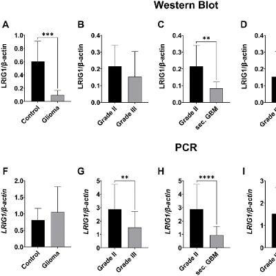Lower LRIG1 Expression Linked to Aggressive Gliomas