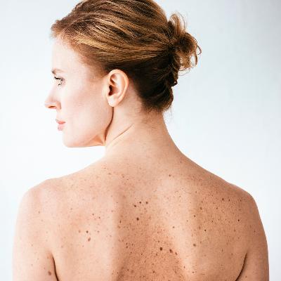 Lumps, and Bumps, and Moles, Oh My!