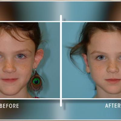 One Childhood Surgery. A Lifetime of Confidence. #podcast #plasticsurgery #beforeandafter One Childhood Surgery. A Lifetime of Confidence. #podcast #plasticsurgery #beforeandafter