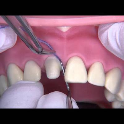 Técnicas de retracción gingival.