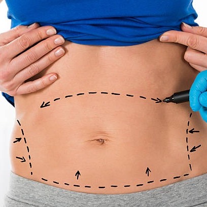 The Transformative Effects of a Tummy Tuck The Transformative Effects of a Tummy Tuck