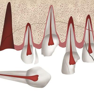 1. TRAUMATISMOS DENTÁRIOS: CONCEITOS E CONTEXTO 1. TRAUMATISMOS DENTÁRIOS: CONCEITOS E CONTEXTO