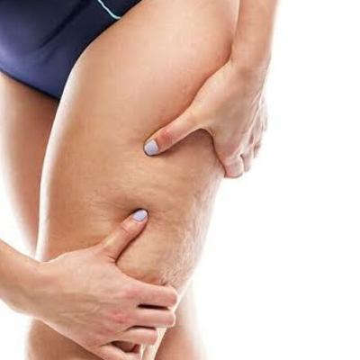 Gordura localizada e Celulite