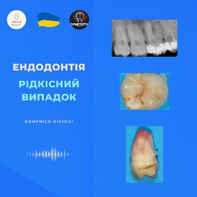 Коли біль вводить в оману: діагностична проблема в ендодонтії