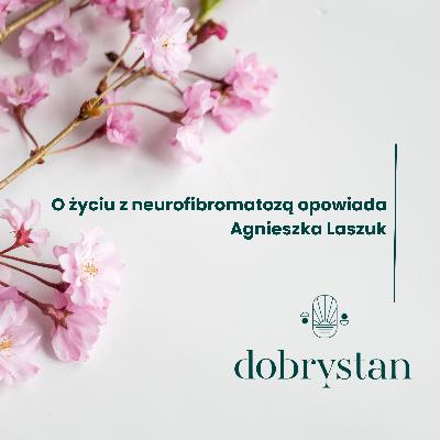 O życiu z neurofibromatozą opowiada Agnieszka Laszuk