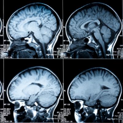 Ep. 35: Alzheimer's Research and Drug Development