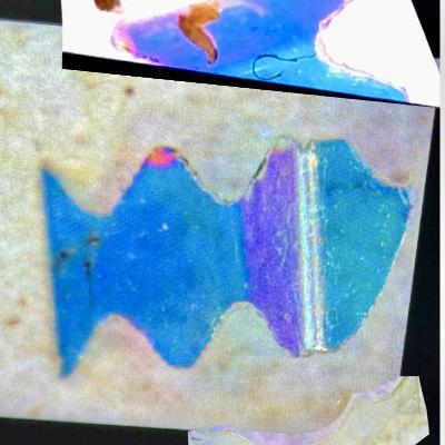Morgellons: A Listener Story