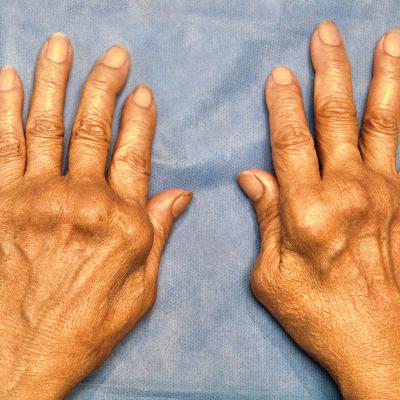 QUÉ ES ARTRITIS REUMATOIDE, CAUSAS, SÍNTOMAS, TRATAMIENTO 👩⚕️ Aprende Fácil y Rápido sobre Salud y Medicina ❤️️ QUÉ ES ARTRITIS REUMATOIDE, CAUSAS, SÍNTOMAS, TRATAMIENTO 👩⚕️ Aprende Fácil y Rápido sobre Salud y Medicina ❤️️