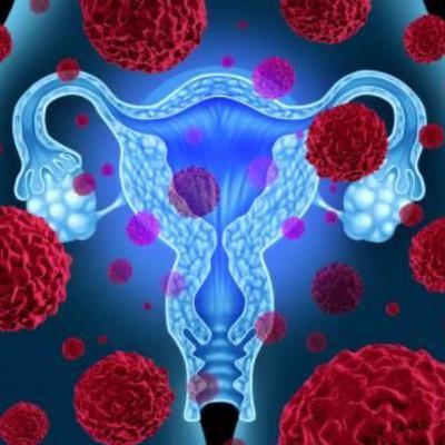 Cancer cervicouterino