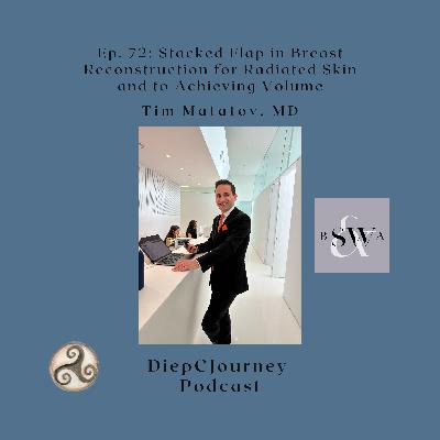 Episode 72: Stacked Flap in Breast Reconstruction for Radiated Skin and to Achieve Volume
