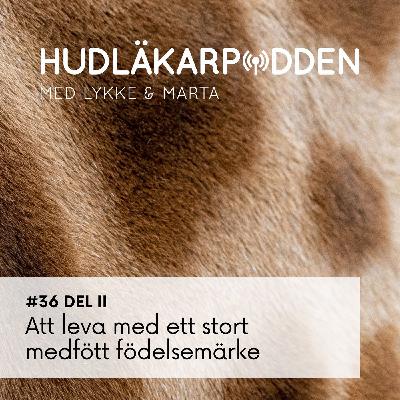 #36 del 2 - Att leva med ett stort medfött födelsemärke