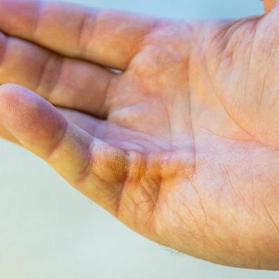 Ep. 31: An Overview Of Dupuytren’s…And What To Look Out For