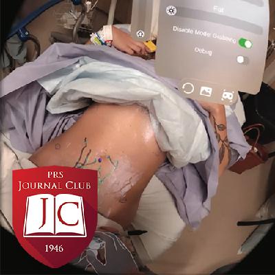 "Augmented Reality for DIEP Flaps" with Chris Campbell, MD - Jun. 2025 Journal Club