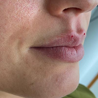 Lippen aufspritzen Schönheitschirurgie Mc Aesthetics Lippen aufspritzen Schönheitschirurgie Mc Aesthetics