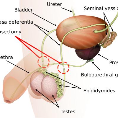 Get a Fucking Vasectomy Get a Fucking Vasectomy