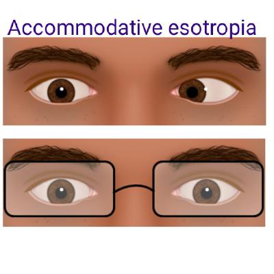 Accommodative Esotropia