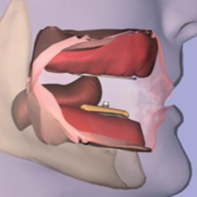 Registro Intraoral e Arco Gótico de Gysi
