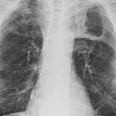 Episode 140 - Tuberculosis in World War I with Eric Story Episode 140 - Tuberculosis in World War I with Eric Story