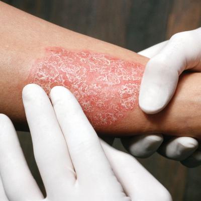 PSORIASIS, CAUSAS, SÍNTOMAS, DESENCADENANTES Y TRATAMIENTO RECOMENDADO 👩⚕️ ❤️️ Aprende Fácil sobre Salud y Medicina PSORIASIS, CAUSAS, SÍNTOMAS, DESENCADENANTES Y TRATAMIENTO RECOMENDADO 👩⚕️ ❤️️ Aprende Fácil sobre Salud y Medicina