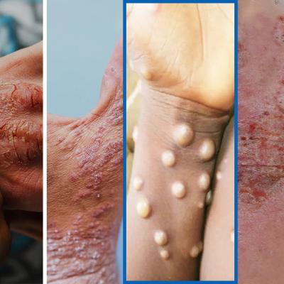 Virus de la Viruela del Mono, el raro virus que se expande por el mundo
